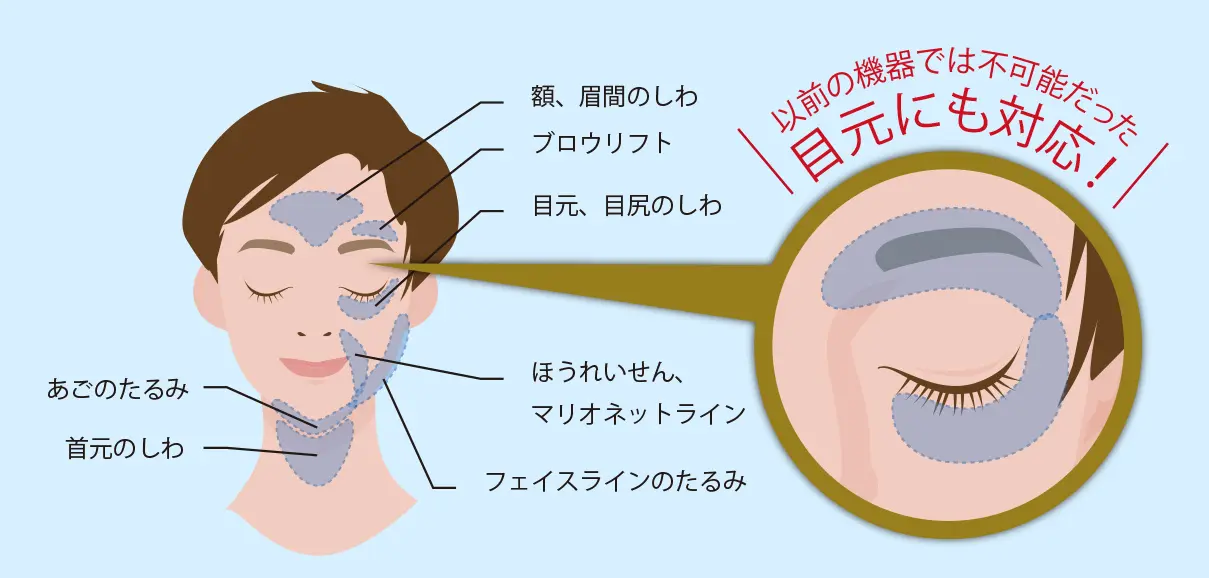 HIFU | やまだ皮フ科クリニック HIFU | やまだ皮フ科クリニック
